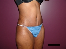 Tummy Tuck After Photo by Moneer Jaibaji, MD; Coronado, CA - Case 21625