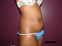 Tummy Tuck Before Photo by Moneer Jaibaji, MD; Coronado, CA - Case 21625