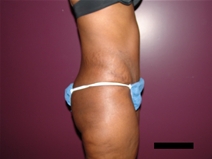 Tummy Tuck After Photo by Moneer Jaibaji, MD; Coronado, CA - Case 21625