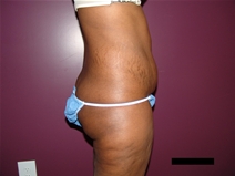 Tummy Tuck Before Photo by Moneer Jaibaji, MD; Coronado, CA - Case 21625