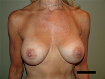 Breast Augmentation After Photo by Moneer Jaibaji, MD; Coronado, CA - Case 21626