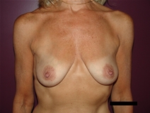 Breast Augmentation Before Photo by Moneer Jaibaji, MD; Coronado, CA - Case 21626