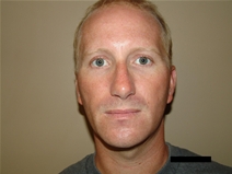 Rhinoplasty After Photo by Moneer Jaibaji, MD; Coronado, CA - Case 21882