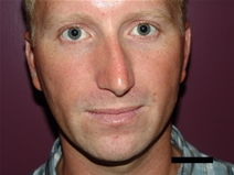 Rhinoplasty Before Photo by Moneer Jaibaji, MD; Coronado, CA - Case 21882