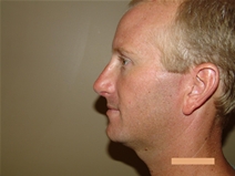 Rhinoplasty After Photo by Moneer Jaibaji, MD; Coronado, CA - Case 21882