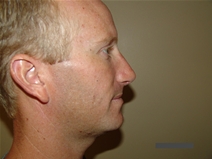 Rhinoplasty After Photo by Moneer Jaibaji, MD; Coronado, CA - Case 21882
