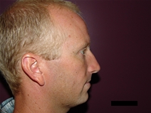 Rhinoplasty Before Photo by Moneer Jaibaji, MD; Coronado, CA - Case 21882