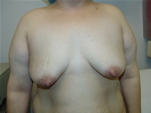 Breast Lift Before Photo by Moneer Jaibaji, MD; Coronado, CA - Case 21927
