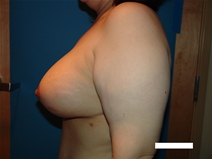 Breast Lift After Photo by Moneer Jaibaji, MD; Coronado, CA - Case 21927