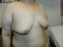 Breast Lift Before Photo by Moneer Jaibaji, MD; Coronado, CA - Case 21927