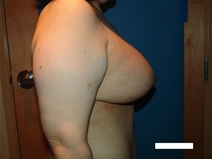 Breast Lift After Photo by Moneer Jaibaji, MD; Coronado, CA - Case 21927