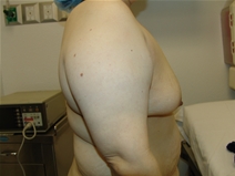 Breast Lift Before Photo by Moneer Jaibaji, MD; Coronado, CA - Case 21927
