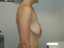 Breast Lift Before Photo by Moneer Jaibaji, MD; Coronado, CA - Case 21928