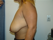 Breast Lift Before Photo by Moneer Jaibaji, MD; Coronado, CA - Case 21929