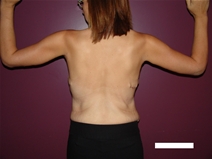 Arm Lift After Photo by Moneer Jaibaji, MD; Coronado, CA - Case 21937