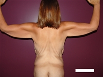 Arm Lift Before Photo by Moneer Jaibaji, MD; Coronado, CA - Case 21937