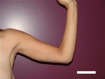 Arm Lift After Photo by Moneer Jaibaji, MD; Coronado, CA - Case 21937