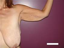 Arm Lift Before Photo by Moneer Jaibaji, MD; Coronado, CA - Case 21937
