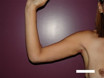 Arm Lift After Photo by Moneer Jaibaji, MD; Coronado, CA - Case 21937