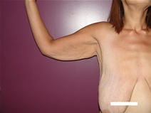 Arm Lift Before Photo by Moneer Jaibaji, MD; Coronado, CA - Case 21937
