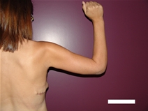 Arm Lift After Photo by Moneer Jaibaji, MD; Coronado, CA - Case 21937