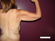 Arm Lift Before Photo by Moneer Jaibaji, MD; Coronado, CA - Case 21937