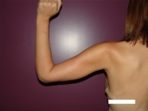 Arm Lift After Photo by Moneer Jaibaji, MD; Coronado, CA - Case 21937