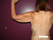 Arm Lift Before Photo by Moneer Jaibaji, MD; Coronado, CA - Case 21937