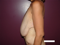 Body Contouring Before Photo by Moneer Jaibaji, MD; Coronado, CA - Case 21939