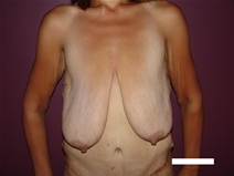 Breast Reduction Before Photo by Moneer Jaibaji, MD; Coronado, CA - Case 21941