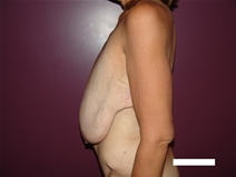 Breast Reduction Before Photo by Moneer Jaibaji, MD; Coronado, CA - Case 21941