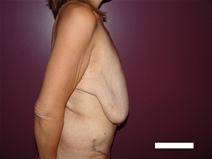 Breast Reduction Before Photo by Moneer Jaibaji, MD; Coronado, CA - Case 21941