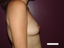 Breast Augmentation Before Photo by Moneer Jaibaji, MD; Coronado, CA - Case 22087