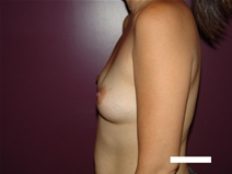 Breast Augmentation Before Photo by Moneer Jaibaji, MD; Coronado, CA - Case 22087