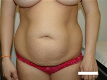 Tummy Tuck Before Photo by Moneer Jaibaji, MD; Coronado, CA - Case 22162