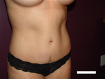 Tummy Tuck After Photo by Moneer Jaibaji, MD; Coronado, CA - Case 22162