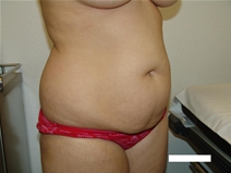 Tummy Tuck Before Photo by Moneer Jaibaji, MD; Coronado, CA - Case 22162