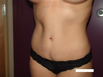 Tummy Tuck After Photo by Moneer Jaibaji, MD; Coronado, CA - Case 22162
