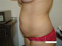 Tummy Tuck Before Photo by Moneer Jaibaji, MD; Coronado, CA - Case 22162