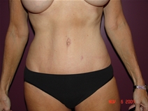 Tummy Tuck After Photo by Moneer Jaibaji, MD; Coronado, CA - Case 22186