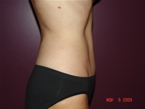 Tummy Tuck After Photo by Moneer Jaibaji, MD; Coronado, CA - Case 22186