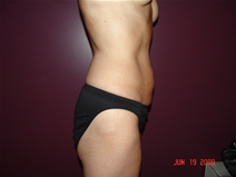 Tummy Tuck Before Photo by Moneer Jaibaji, MD; Coronado, CA - Case 22186