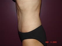 Tummy Tuck After Photo by Moneer Jaibaji, MD; Coronado, CA - Case 22186
