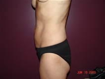 Tummy Tuck Before Photo by Moneer Jaibaji, MD; Coronado, CA - Case 22186