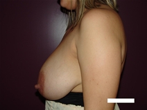 Breast Reduction Before Photo by Moneer Jaibaji, MD; Coronado, CA - Case 22246