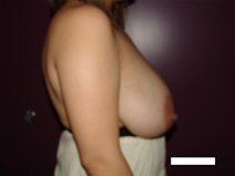 Breast Reduction Before Photo by Moneer Jaibaji, MD; Coronado, CA - Case 22246