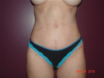 Tummy Tuck After Photo by Moneer Jaibaji, MD; Coronado, CA - Case 22327