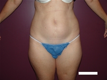 Tummy Tuck Before Photo by Moneer Jaibaji, MD; Coronado, CA - Case 22327