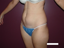 Tummy Tuck Before Photo by Moneer Jaibaji, MD; Coronado, CA - Case 22327