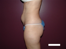 Tummy Tuck Before Photo by Moneer Jaibaji, MD; Coronado, CA - Case 22327